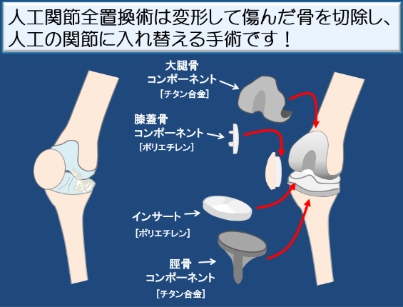 人工膝関節置換術