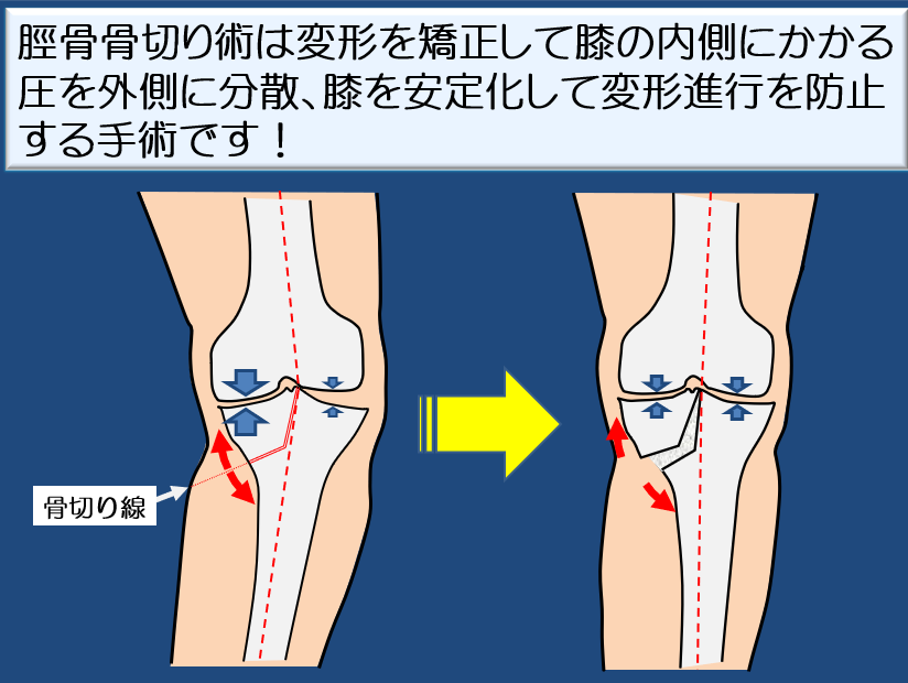 脛骨顆外反骨切り術